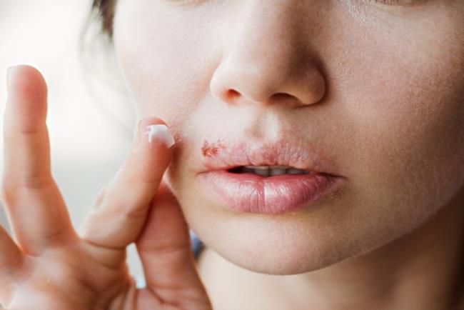 אישה סובלת מפצע הרפס על השפתיים' אלאציקלוביר (ולטרקס, Valtrex, ולוויר)